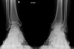 El diagnóstico de la artrosis de tobillo se realiza con radiografías simples del tobillo, preferiblemente en carga. Para estudiar mejor el caso puede ser útil la realización de un TAC o una resonancia magnética.