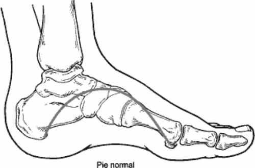 La Disfunción del Tendón Tibial Posterior es llamada a menudo un "pie plano adquirido de adulto" porque es el tipo de pie plano más común que se desarrolla en la madurez.
