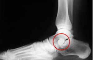 Radiografía lateral con implante colocado correctamente en pie plano flexible