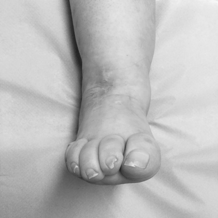 Paciente con pie equino varo. Imagen postquirúrgica a los 5 meses