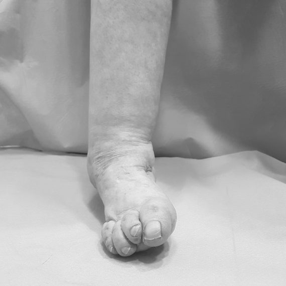 Cirugía Avanzada de Pie Centro Clínico Quirúrgico Aranjuez