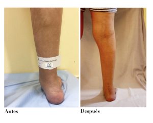 transposicion tendinosa en el tobillo y pie
