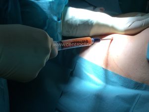 Lipofilling plantar
