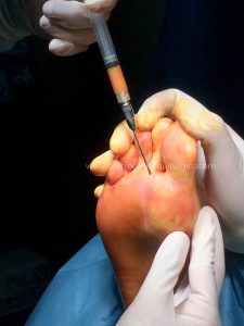 Lipofilling plantar