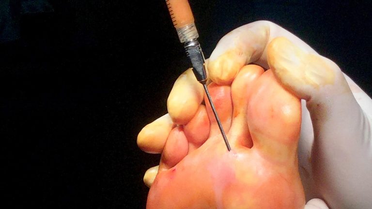 lipofilling plantar