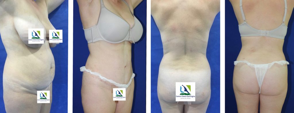 Abdominoplastia
