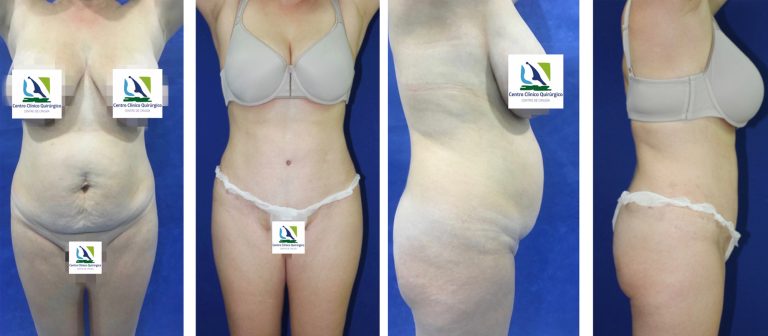 Abdominoplastia