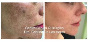 manchas faciales