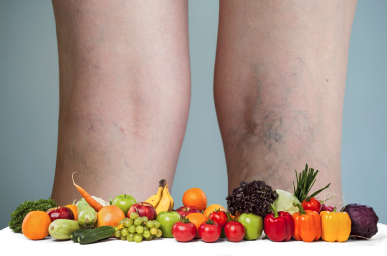 Alimentación y varices