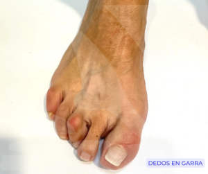 Dedos en garra
