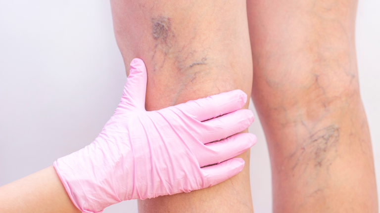 Cuidados varices y microvarices