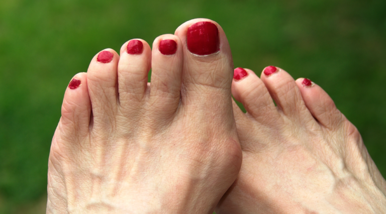 Hallux abductus valgus
