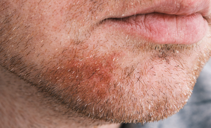 Dermatitis seborreica