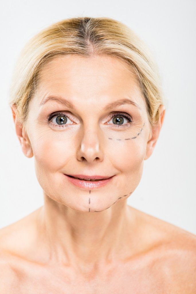 rejuvenecimiento facial en mujer madura tras tratamiento de medicina estética