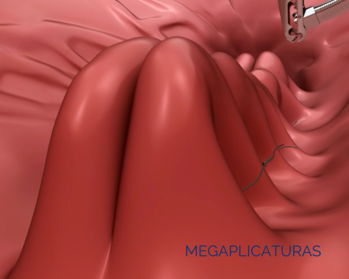 Qué es el Método MEGA