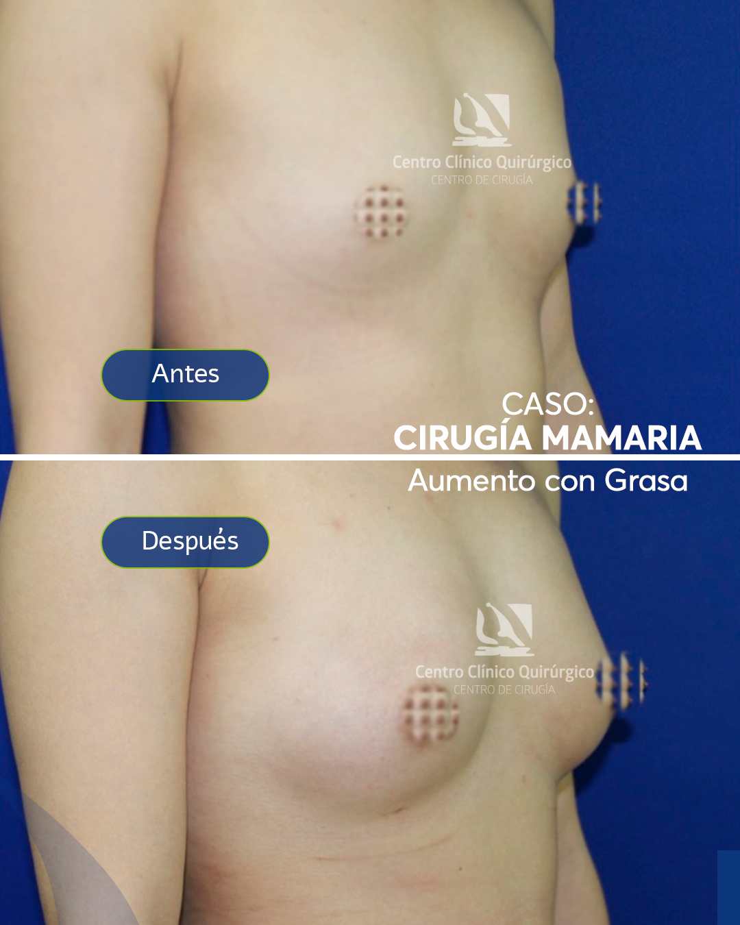 ARANJUEZ--caso-AD-cirugia-mamaria-aumento-con-grasa