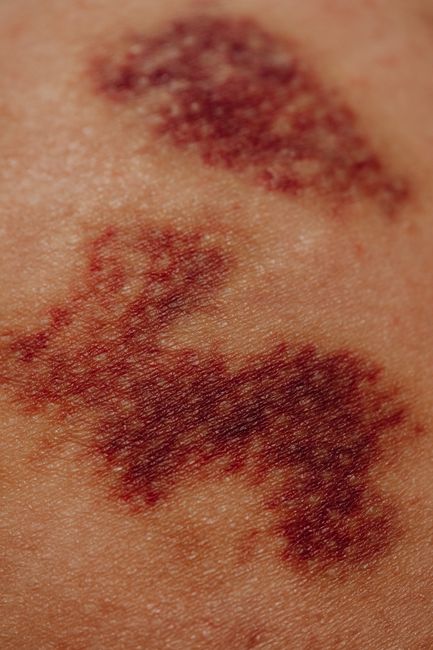 Neuralgia postherpética, dolor persistente tras el herpes zóster